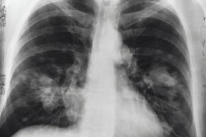 Capai 845.000 Kasus, Tingkat Kematian TBC di Indonesia Tinggi